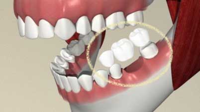 removing teeth image