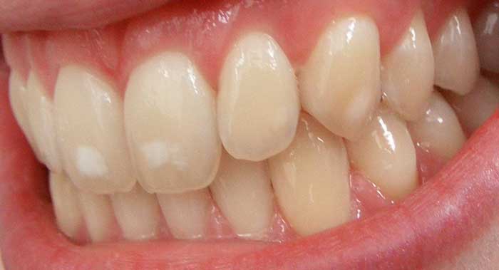 teeths image